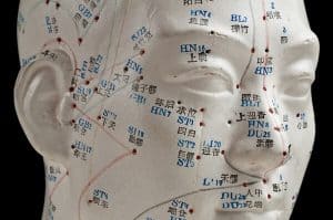 נקודות דיקור