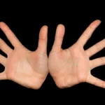 נימולים באצבעות הידיים